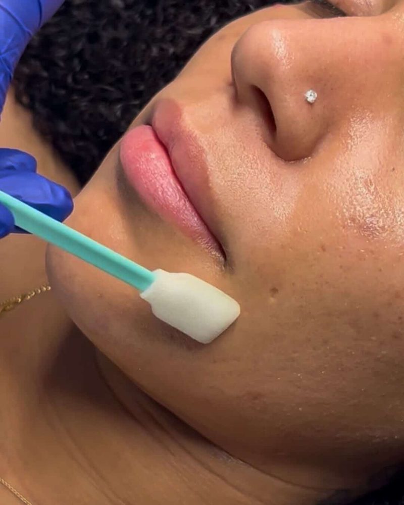 Chemical peel application at Kamil Esthétique