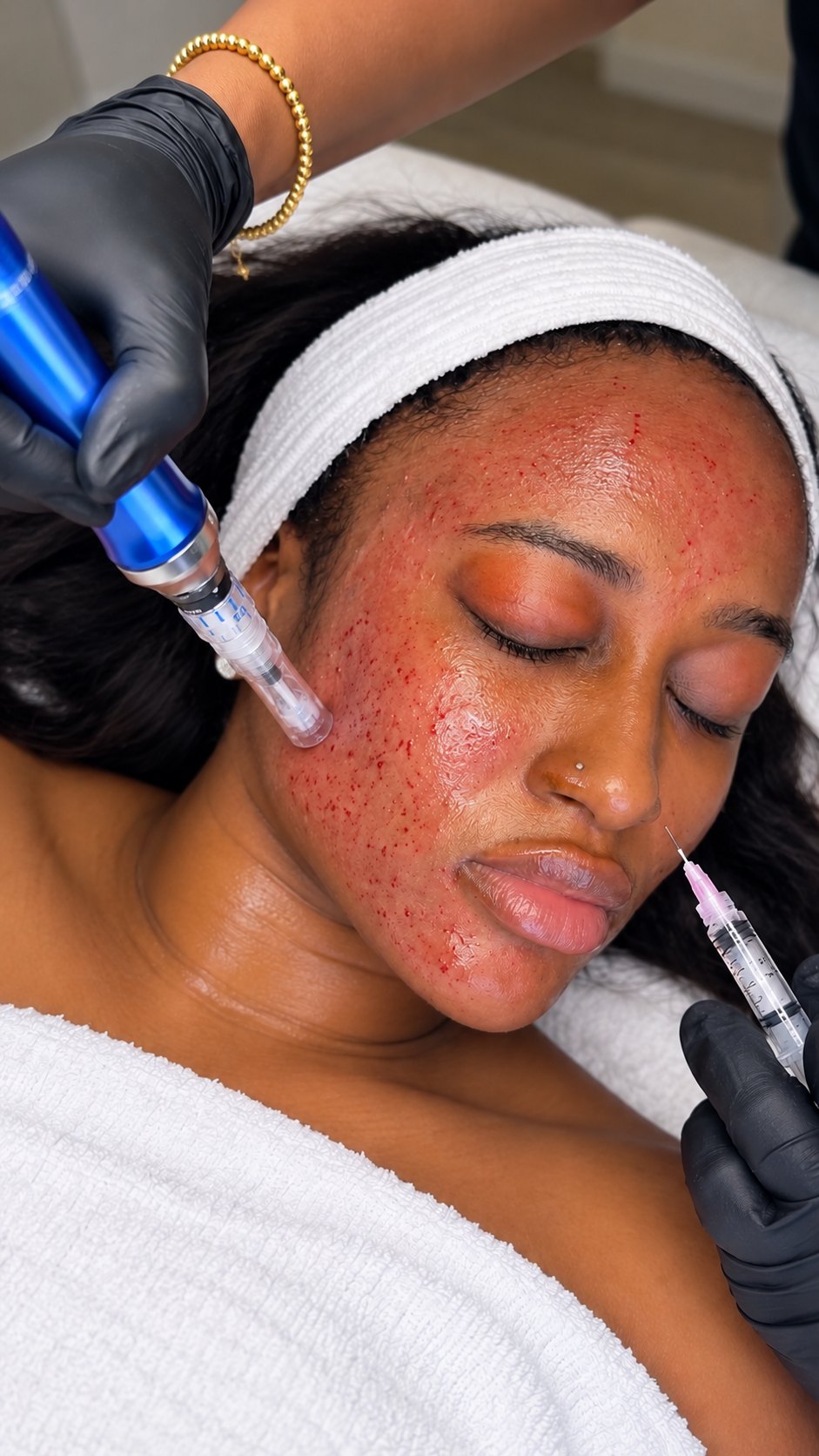 Microneedling treatment in progress at Kamil Esthétique